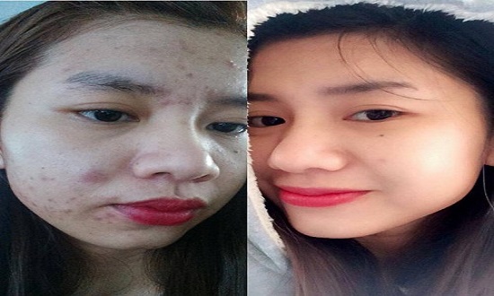 Chỉ cần chà một viên đá sữa lên mặt mỗi ngày, da trắng hồng, mụn cũng đánh bay