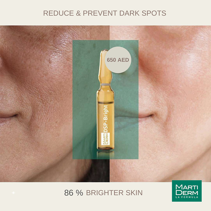 Đặc trị thâm, nám do nhiều nguyên nhân khác nhau