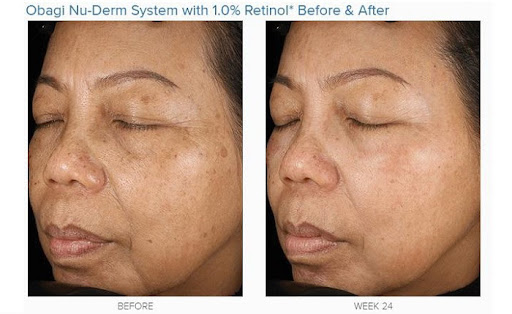 Tình trạng nám da được cải thiện rõ rệt sau 8 - 12 tuần, da sáng mịn, trẻ trung hơn Tình trạng nám da được cải thiện rõ rệt sau 8 - 12 tuần, da sáng mịn, trẻ trung hơn
