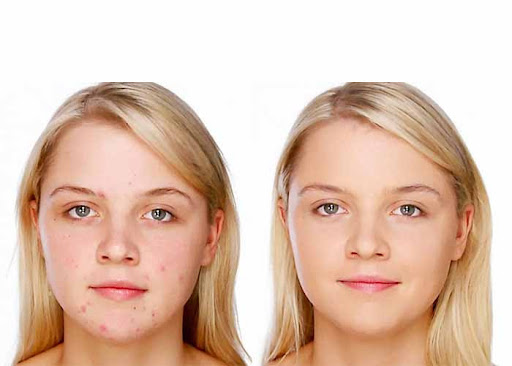 Kem che khuyết điểm Eucerin ProAcne CC Stick và những công dụng bất ngờ