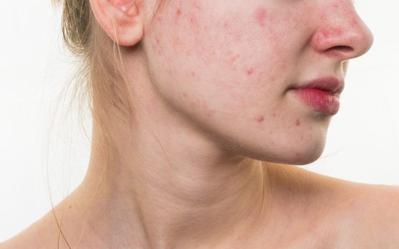 Chọn kem chống nắng cho da mụn