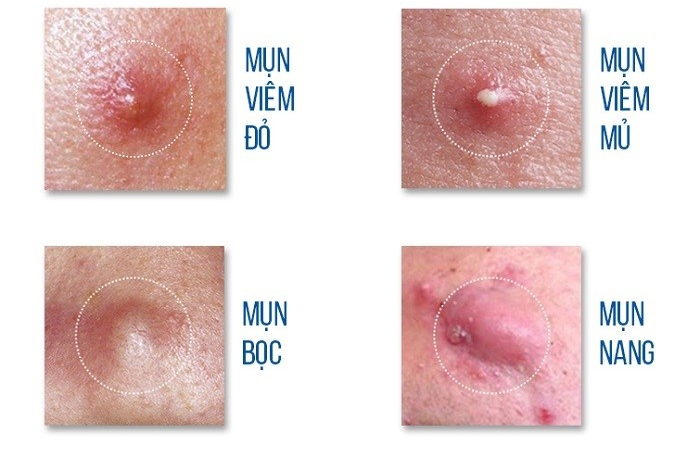Nên xác định loại mụn viêm đang bị trước khi tìm cách trị mụn viêm Nên xác định loại mụn viêm đang bị trước khi tìm cách trị mụn viêm