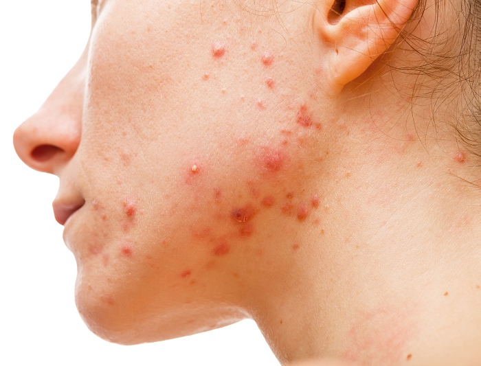 Mụn viêm là loại mụn khó điều trị, dễ để lại thâm sẹo Mụn viêm là loại mụn khó điều trị, dễ để lại thâm sẹo