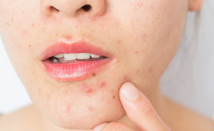 Gợi ý cách trị mụn viêm hiệu quả Gợi ý cách trị mụn viêm hiệu quả