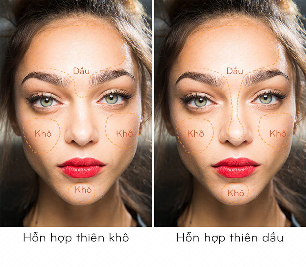 Hỗn hợp thiên khô là loại da có sự phân bố không đồng đều về tỷ lệ dầu và nước trên da. Trong đó, vùng da khô (vùng chữ U) chiếm nhiều diện tích hơn vùng da dầu (vùng chữ T). Khu vực da khô thì thô ráp, bong tróc, dễ nổi mẩn đỏ, nhiều nếp nhăn, da dầu thì nhiều bã nhờn, dư dầu, lỗ chân lông to. 