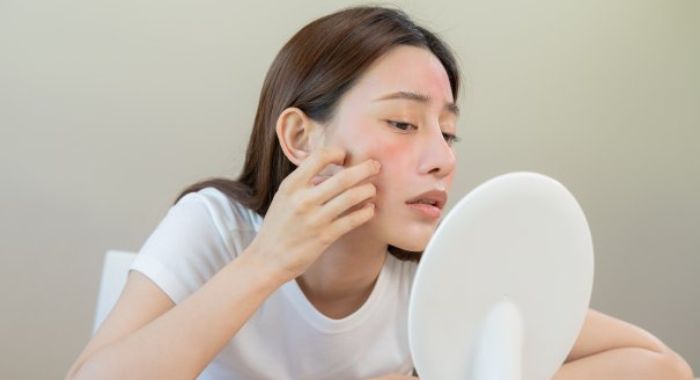 Kem dưỡng ẩm cho da dầu mụn đang treatment cần có thành phần gì?
