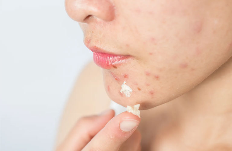 Top 10 kem hỗ trợ giảm mụn trắng da an toàn, dưỡng da mịn màng, tươi trẻ