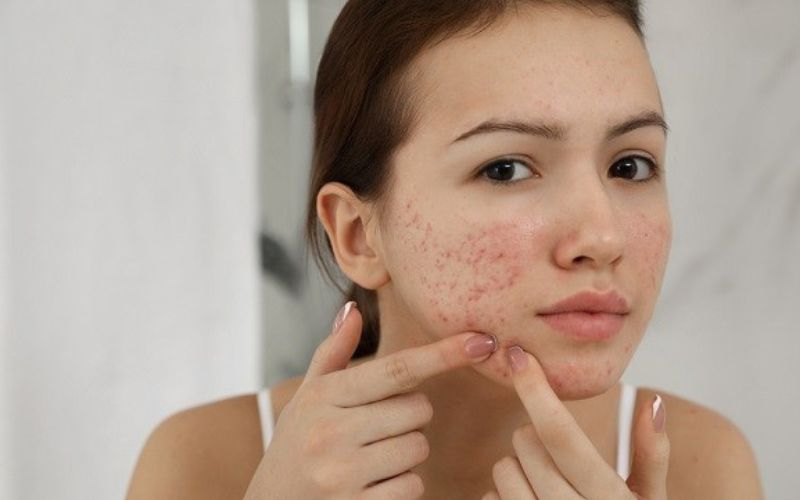 Chăm sóc da sau nặn mụn: 5 cách ngừa sẹo và thâm mụn • Hello Bacsi