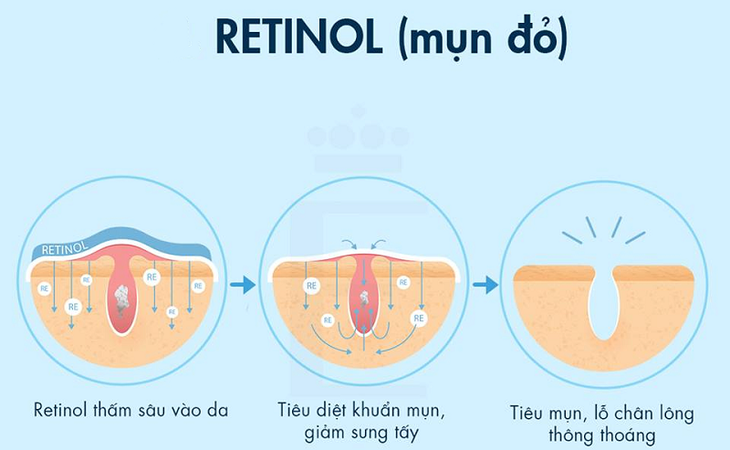 Retinol có tác dụng cải thiện mụn và lỗ chân lông Retinol có tác dụng cải thiện mụn và lỗ chân lông