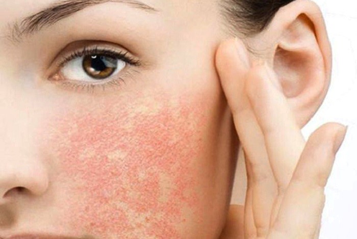 Tại sao cần dùng sản phẩm chuyên biệt dành cho da dị ứng