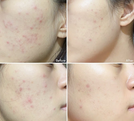 Paula’s Choice 1% Retinol Booster giúp kháng viêm, hỗ trợ trị mụn và phục hồi da bị tổn thương do mụn Paula’s Choice 1% Retinol Booster giúp kháng viêm, hỗ trợ trị mụn và phục hồi da bị tổn thương do mụn