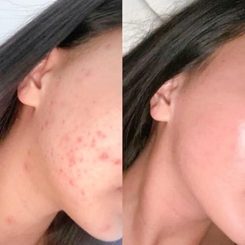 Gel loại bỏ tế bào chết Paula’s Choice Skin Perfecting 2% Bha Gel Exfoliant