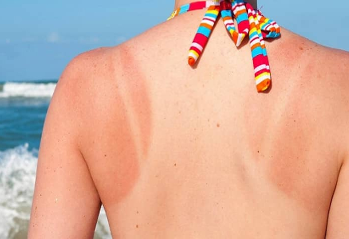 Tia UV có thể gây đỏ da, sạm da, cháy nắng hoặc ung thư da Tia UV có thể gây đỏ da, sạm da, cháy nắng hoặc ung thư da