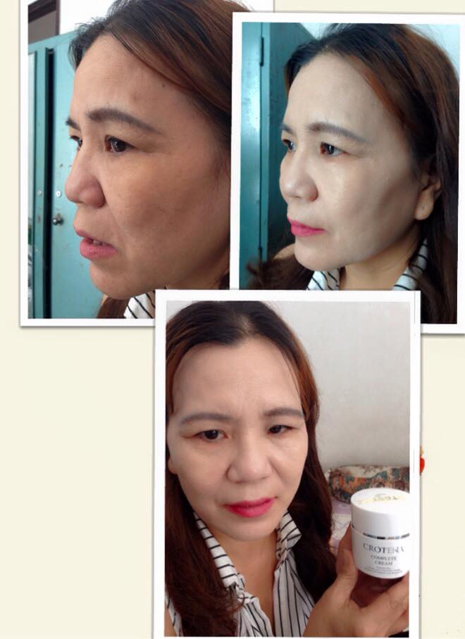 Hiệu quả trước và ngay sau khi thoa Crotena Complete Cream Hiệu quả trước và ngay sau khi thoa Crotena Complete Cream