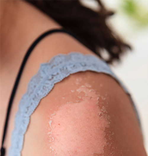 Da bị cháy nắng ảnh hưởng đến thẩm mỹ và gây cảm giác khó chịu
