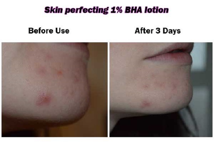 Skin Perfecting 2% BHA Liquid Exfoliant được khách hàng tin dùng Skin Perfecting 2% BHA Liquid Exfoliant được khách hàng tin dùng