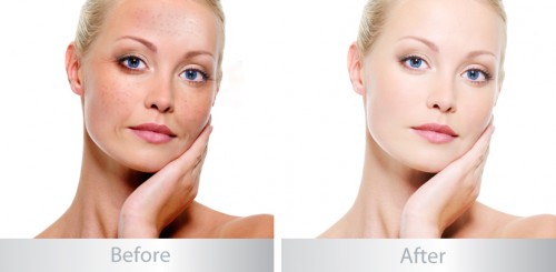 Trước và sau khi điều trị nám bằng kem hỗ trợ làm mờ nám Shiseido Trước và sau khi điều trị nám bằng kem hỗ trợ làm mờ nám Shiseido