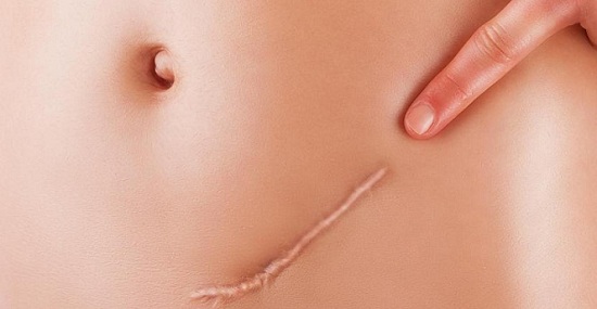 Sẹo để lại do phẫu thuật