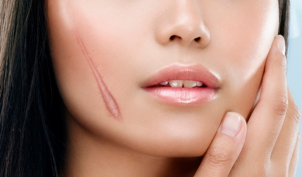 Phân loại sẹo để có cách điều trị phù hợp nhất