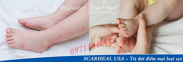 Kem hỗ trợ làm mờ sẹo Scar Esthetique còn cực an toàn với cả làn da trẻ em. Sẹo do côn trùng cắn chỉ cần 3 tuýp kem đã bị xóa bỏ hoàn toàn