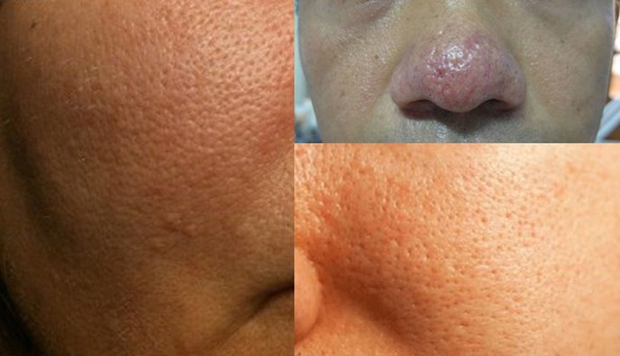 Sẹo rỗ và lỗ chân lông to là tình trạng mà rất nhiều người gặp phải Sẹo rỗ và lỗ chân lông to là tình trạng mà rất nhiều người gặp phải